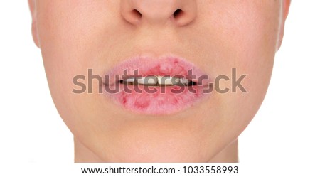 Dermatillomania skin picking. Woman has bad habit to pick her lips. Harmful addiction based on anxiety stress and dry lips. Excoriation disorder. Sick cracked damaged tissue. Royalty-Free Stock Photo #1033558993