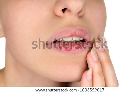 Dermatillomania skin picking. Woman has bad habit to pick her lips. Harmful addiction based on anxiety stress and dry lips. Excoriation disorder. Sick cracked damaged tissue. Royalty-Free Stock Photo #1033559017