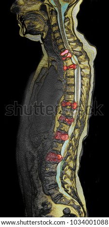 Spinal metastasis, MRI image Royalty-Free Stock Photo #1034001088