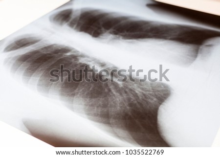 An X-ray picture of a healthy human chest on a white background