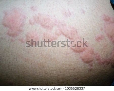 Allergy rash caused by allergy.