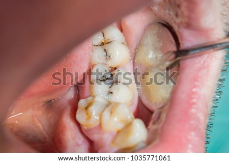 close-up of a human rotten carious tooth at the treatment stage in a dental clinic. The use of rubber dam system with latex scarves and metal clips, production of photopolymeric composite fillings Royalty-Free Stock Photo #1035771061