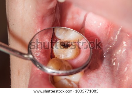 close-up of a human rotten carious tooth at the treatment stage in a dental clinic. The use of rubber dam system with latex scarves and metal clips, production of photopolymeric composite fillings Royalty-Free Stock Photo #1035771085