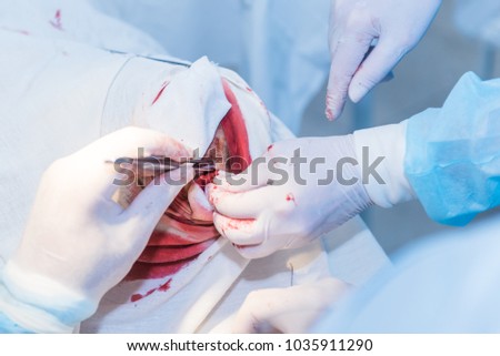 the hands of a surgeon's doctor sewing up the cut of the skin after an operation to remove the atheroma on the patient's head in the hospital. concept photo of professional doctors, painless medicine