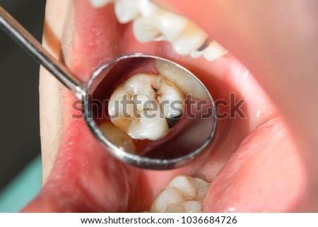 close-up of a human rotten carious tooth at the treatment stage in a dental clinic. The use of rubber dam system with latex scarves and metal clips, production of photopolymeric composite fillings Royalty-Free Stock Photo #1036684726