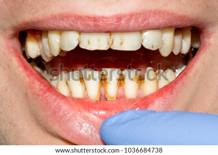 close-up of a human rotten carious tooth at the treatment stage in a dental clinic. The use of rubber dam system with latex scarves and metal clips, production of photopolymeric composite fillings Royalty-Free Stock Photo #1036684738