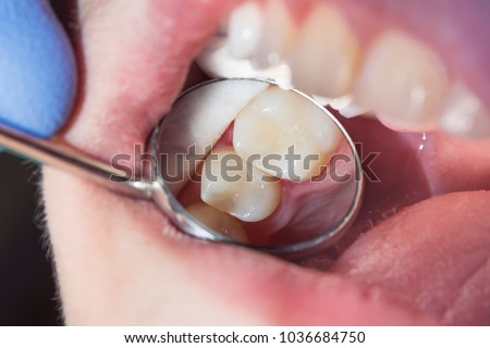 close-up of a human rotten carious tooth at the treatment stage in a dental clinic. The use of rubber dam system with latex scarves and metal clips, production of photopolymeric composite fillings Royalty-Free Stock Photo #1036684750