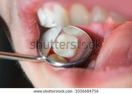 close-up of a human rotten carious tooth at the treatment stage in a dental clinic. The use of rubber dam system with latex scarves and metal clips, production of photopolymeric composite fillings Royalty-Free Stock Photo #1036684756