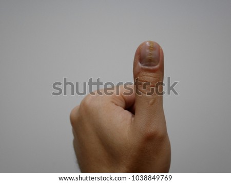 Left Thumb cracking or unhealthy nail
