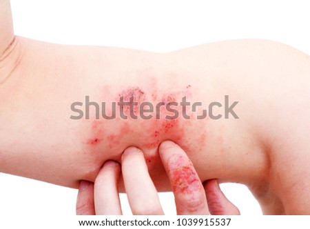 Atopic dermatitis (AD), also known as atopic eczema, is a type of inflammation of the skin (dermatitis) at foot.
 Royalty-Free Stock Photo #1039915537