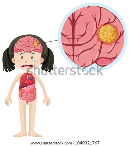 Little girl and brain cancer illustration