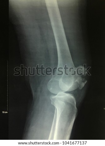 X-ray image of patient about fracture knee.
