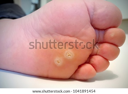 Wart verrucas plantar. Fasciitis Wart on foot. Decease on foot skin. Wart plantar callus foot . Warts plantar verruca foot
 Royalty-Free Stock Photo #1041891454