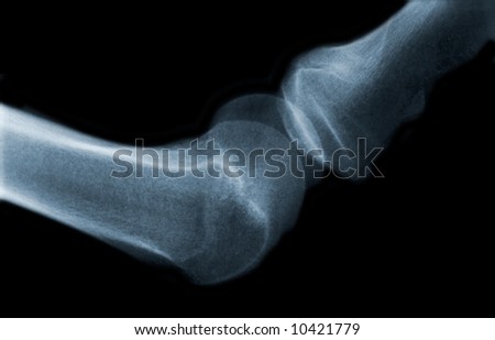 X-ray picture of knee