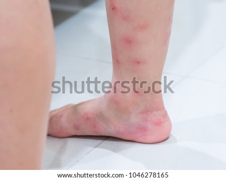 Red blisters on a girl's legs after ants bite (Solenopsis geminata ,tropical fire ant ). Royalty-Free Stock Photo #1046278165