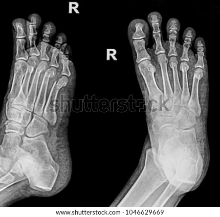 x ray foot