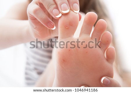 female foot with problem areas on the skin, dry callus. Royalty-Free Stock Photo #1046941186