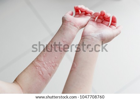 Close up image of kid skin texture suffering severe urticaria, nettle rash. Royalty-Free Stock Photo #1047708760