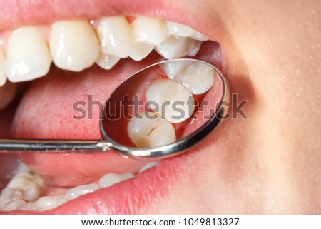 Dental treatment in the dental clinic. Rotten carious tooth close-up macro. Treatment of endodontic canals Royalty-Free Stock Photo #1049813327