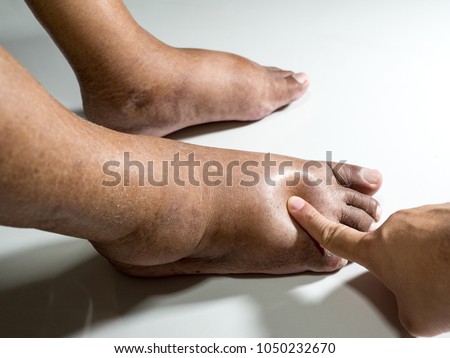 The feet of people with diabetes, dull and swollen. Due to the toxicity of diabetes placed on a white background. Fingers hit the back of the diabetic foot. To test foot swelling. Royalty-Free Stock Photo #1050232670