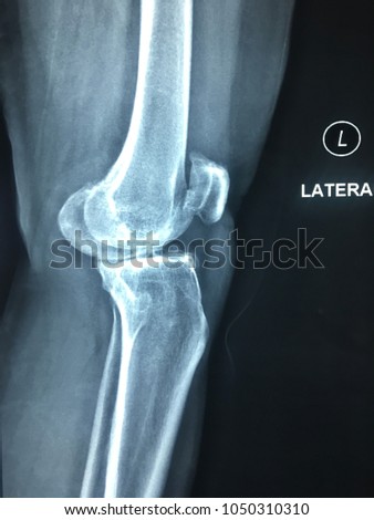 Film x-ray for Osteoarthritis of the Knee or OA knee.