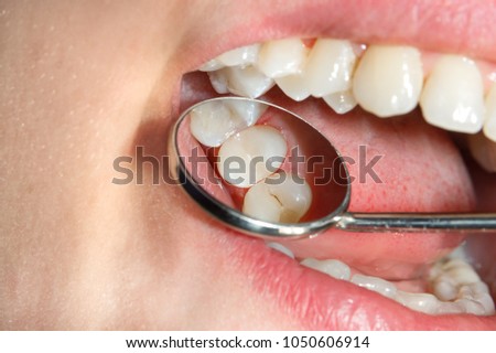 Dental caries. Filling with dental composite photopolymer material using rabbders. The concept of dental treatment in a dental clinic Royalty-Free Stock Photo #1050606914