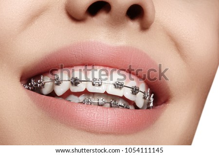 Beautiful macro shot of white teeth with braces. Dental care photo. Beauty woman smile with ortodontic accessories. Orthodontics treatment. Closeup of healthy female mouth Royalty-Free Stock Photo #1054111145