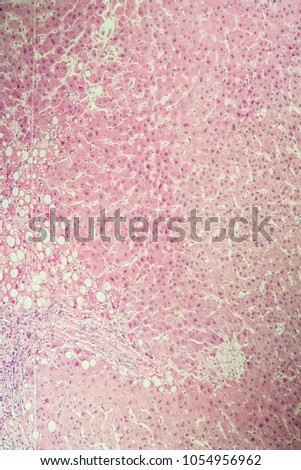 Liver cirrhosis of diseased tissue under the microscope