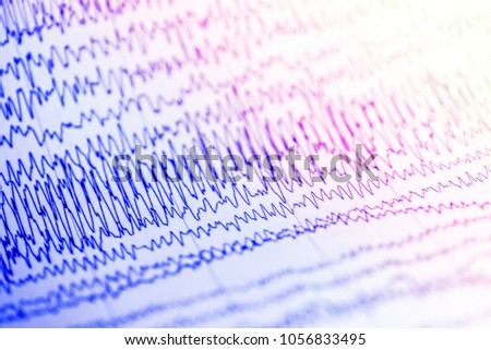 Abnormal  EEG wave form,Abnormal EEG,Brain wave on electroencephalogram ,EEG wave background, Status epilepticus wave form