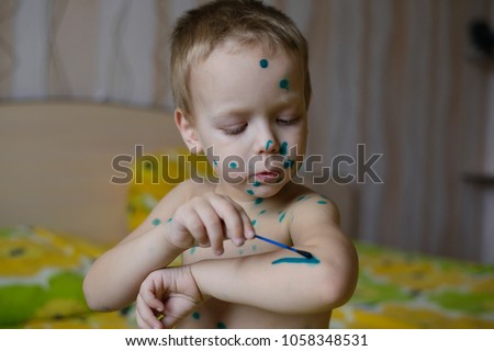 a small a boy with chicken pox, lubricates rashes pan-green the solution Royalty-Free Stock Photo #1058348531