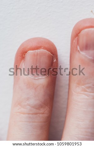 FINGERS ON THE WHITE BACKGROUND. FINGERS A LARGE PLAN. MACRO PHOTO FINGERS HANDS. HANDS of ADULT. DAMAGED NAIL PLATE
