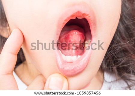 Red and white spot under tongue.Child infected with virus.Herpangina disease,Hand foot and mouth disease, HFMD Royalty-Free Stock Photo #1059857456