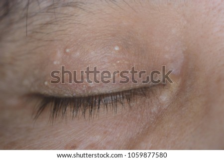 close up of the eyelid inclusion cyst during eye examination. Royalty-Free Stock Photo #1059877580