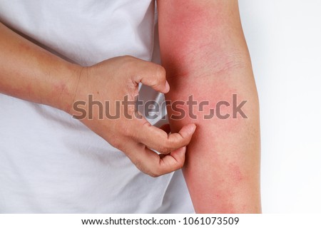 People scratch the itch with hand. Allergic rash dermatitis eczema skin of patient Royalty-Free Stock Photo #1061073509