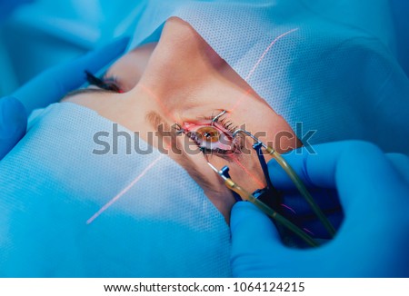 Laser vision correction. A patient and team of surgeons in the operating room during ophthalmic surgery. Eyelid speculum. Lasik treatment. Patient under sterile cover Royalty-Free Stock Photo #1064124215