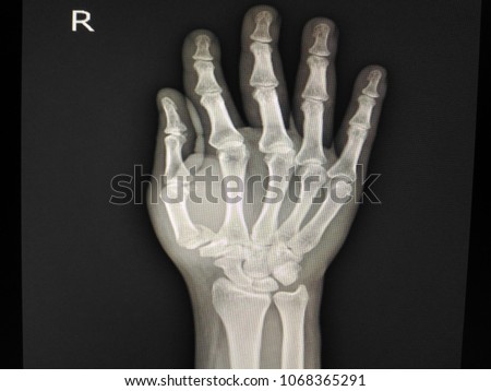X-ray Hand show fracture proximal epiphysis of the 1st metacarpal bone. 
Severe swelling of soft tissue.