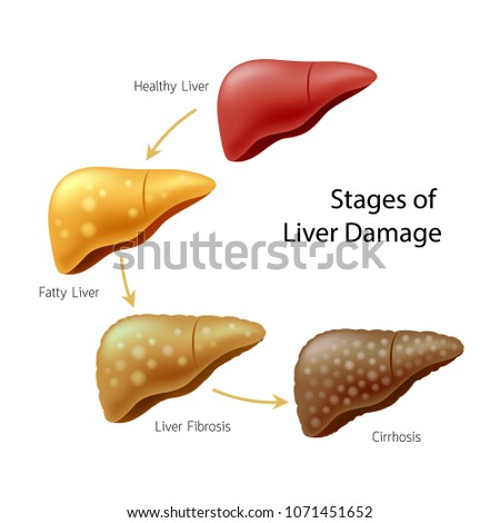 STAGES-OF-LIVER-FIBROSIS Stock Vector Images - Avopix.com