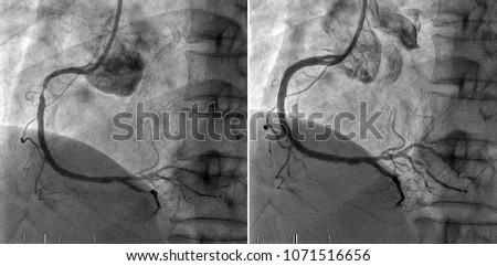 Right coronary angiography,Left side is the disease at right coronary artery and right side is the right coronary artery after Percutaneous Coronary Intervention in cardiac catheterization laboratory.