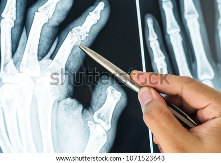 Closeup of x-ray filmof a fractured finger