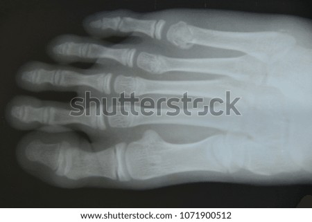Close up bone of foot x-ray film.