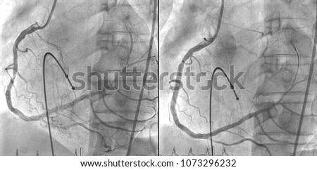 Pre and Post percutaneous coronary Intervention at right coronary artery, support with temporary cardiac pacemaker during procedure in cardiac catheterization laboratory room. Royalty-Free Stock Photo #1073296232