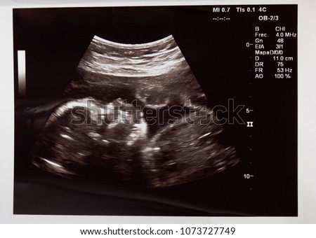 Baby head on ultrasound scan in hospital check