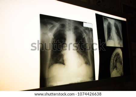 X-ray picture of lungs (chest)