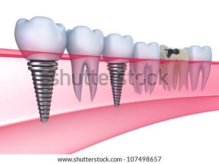 Dental implants in the gum - Isolated on white