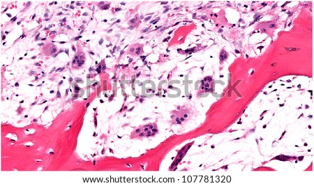 Highly magnified view of bone eating multinucleated osteoclasts along scalloped edges of trabecular bone due to osteoclastic bone resorption Royalty-Free Stock Photo #107781320
