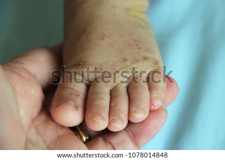 A baby foot was hold showed lesions Erythematous, excoriated papules are present on the foot as scabies. The rashes are itchy small, vesicular, redness, dry scaly on dorsal foot and webs of the toes Royalty-Free Stock Photo #1078014848