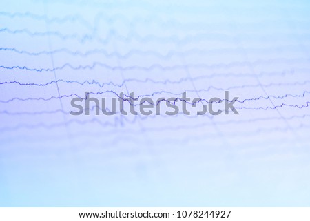Abnormal EEG waveform, Abnormal EEG, Brainwave on electroencephalogram, EEG wave background, Status epilepticus waveform.