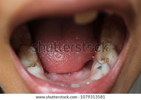
Tooth decay due to not brushing