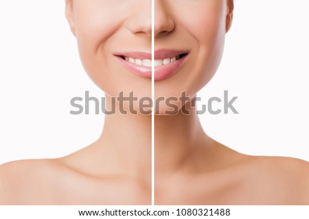 Beautiful plump Lips after filler injection collagen to increase the volume of the lips. Beauty concept. Female lips before and after augmentation procedure - Image                             