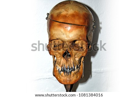 Human skull with silver teeth